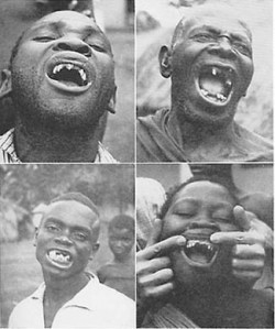 "Wherever the Africans have aidopted the foods of modern commerce, dental caries was active, thus destroying large numbers of the teeth and causing great suffering. The cases shown here are typical of workers on plantations which largely use imported foods."